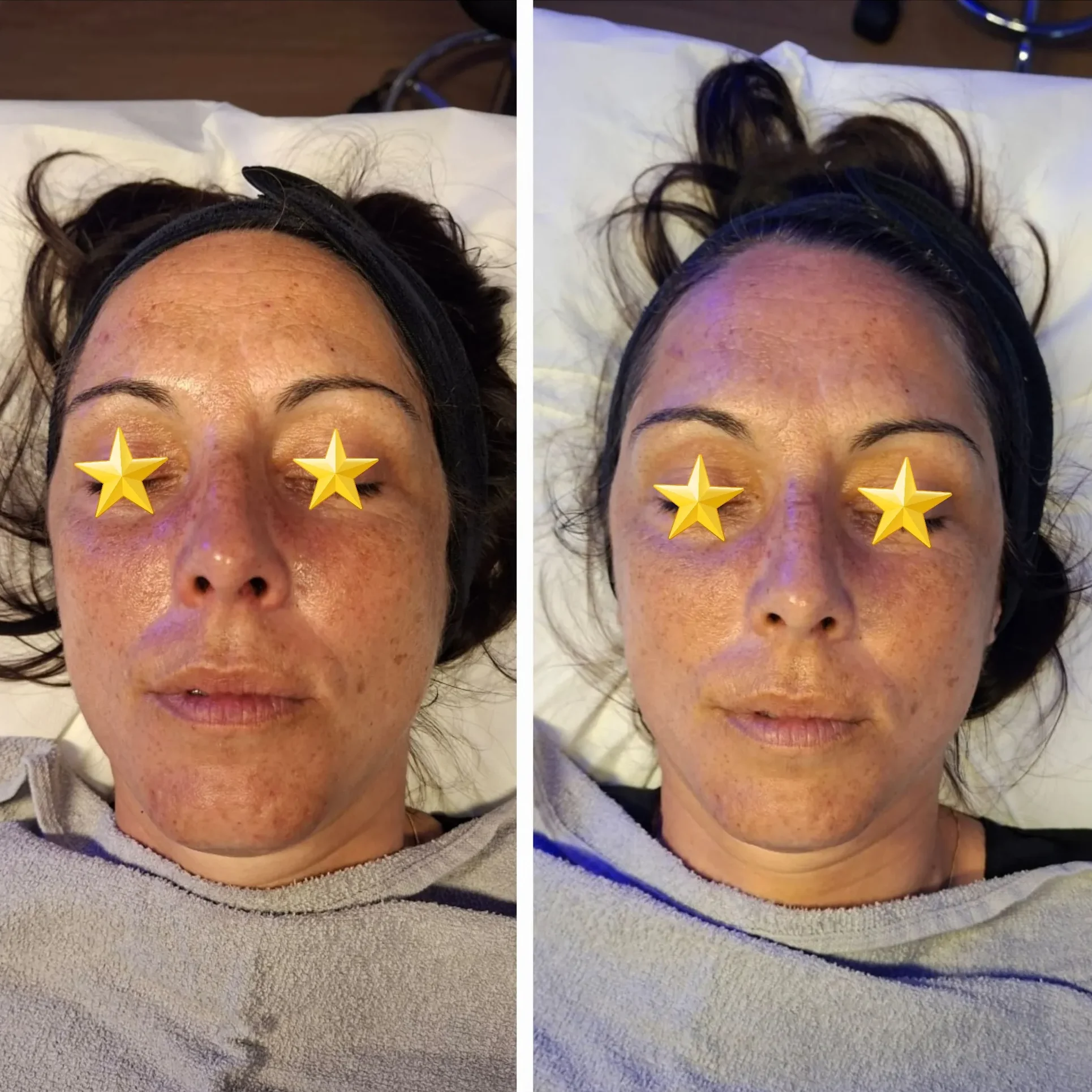 Avant/après soin visage, yeux étoilés